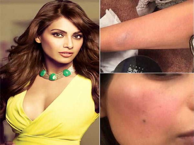 bipasha-basu-suffered-multiple-burns-on-her-face-niharonline